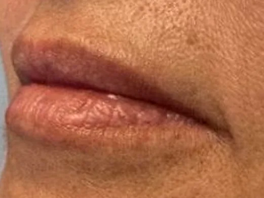 Before: the same guest's lips, left angle, before lip filler