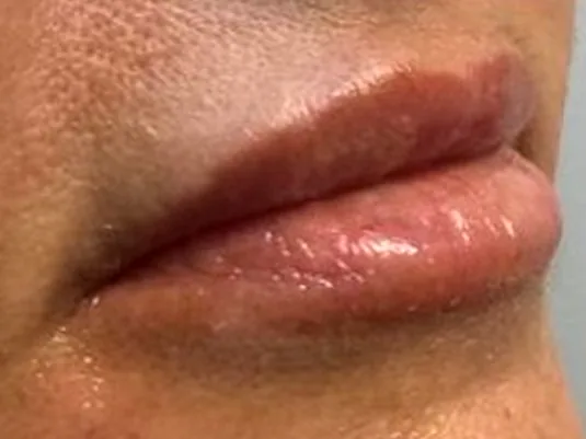 After: the same guest's lips, right angle, after lip filler