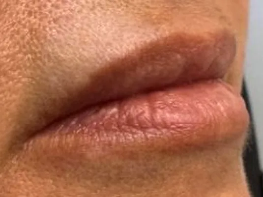 Before: the same guest's lips, right angle, before lip filler