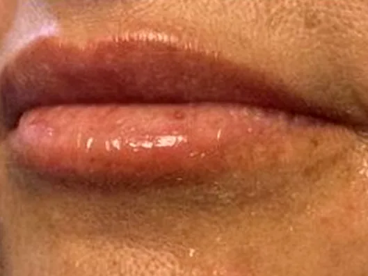 After: the same guest's lips, front view, after lip filler