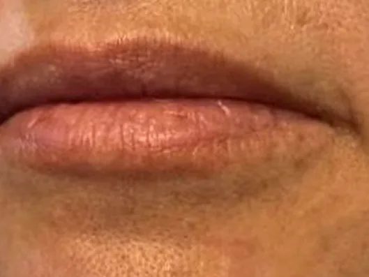 Before: a guest's lips, front view, before lip filler