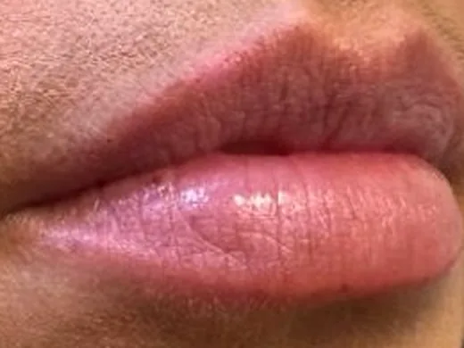 Before: the same guest's lips, right angle, before lip filler