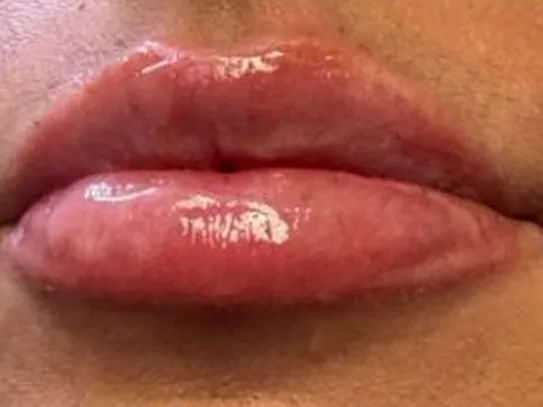 After: the same guest's lips, front view, after lip filler