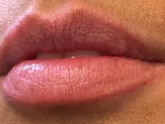 Before: a guest's lips, front view, before lip filler