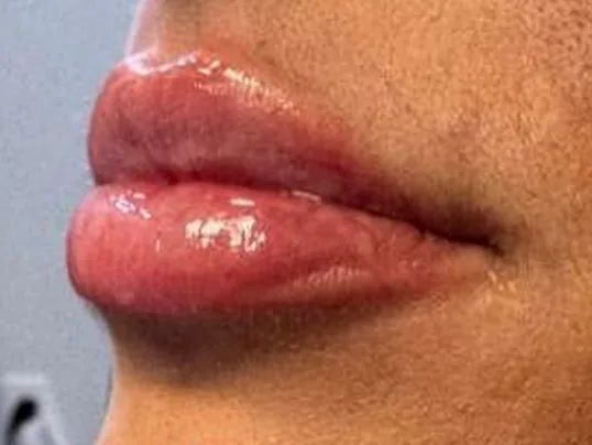 After: the same guest's lips, left side view, after lip filler