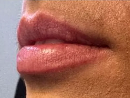 Before: the same guest's lips, left side view, before lip filler