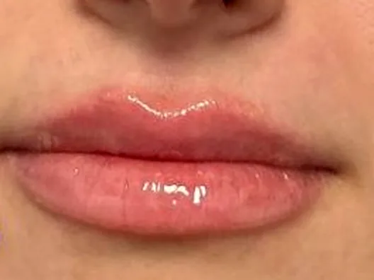 After: the same guest's lips, front view, after a customized lip treatment