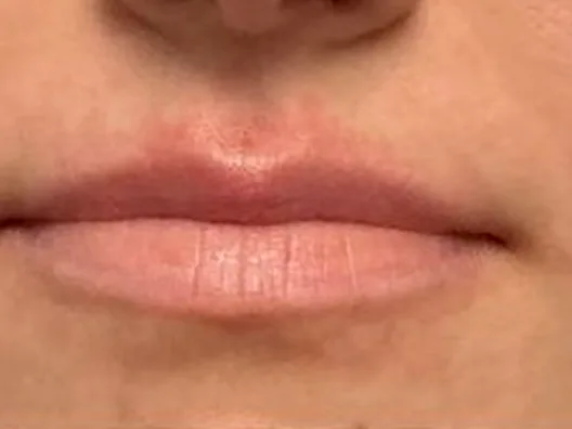 Before: a guest's lips, front view, before a customized lip treatment