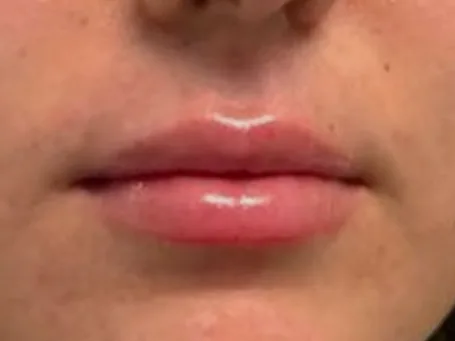 After: the same guest's lips, front view, after lip filler