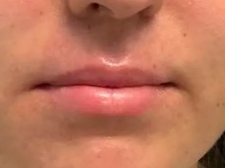 Before: a guest's lips, front view, before lip filler