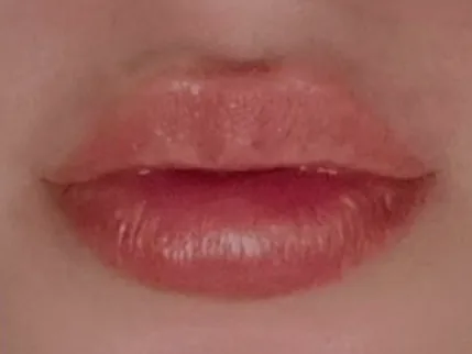After: the same guest's lips, front view, after lip filler