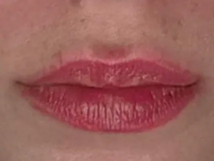 Before: a guest's lips, front view, before lip filler