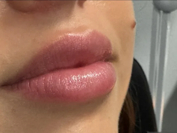 Two weeks: the same guest's lips settled, two weeks after lip filler