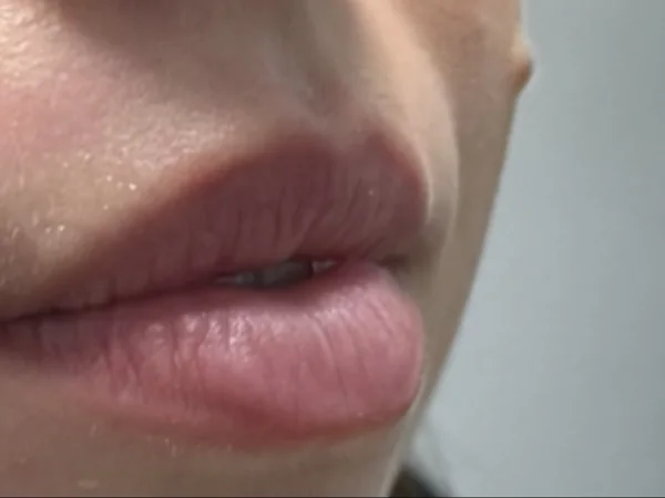 Before: a guest's lips, angle view, before lip filler