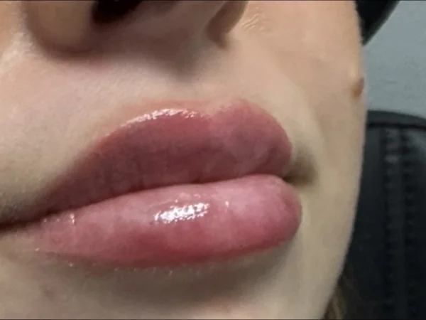 Right after: the same guest's lips minutes after lip filler, with swelling