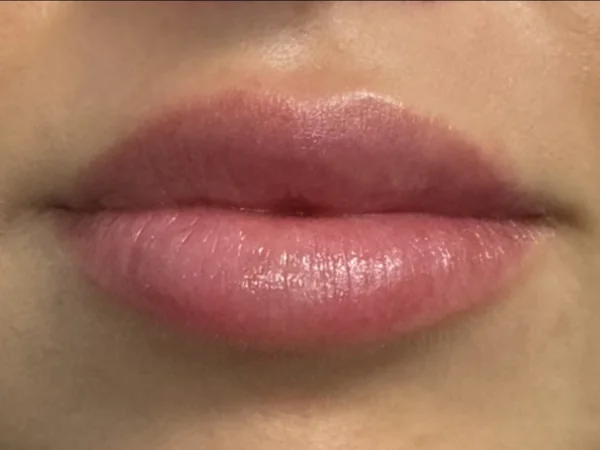 Two weeks: the same guest's lips settled, two weeks after lip filler