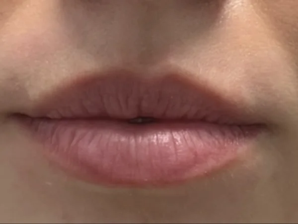 Before: a guest's lips, front view, before lip filler