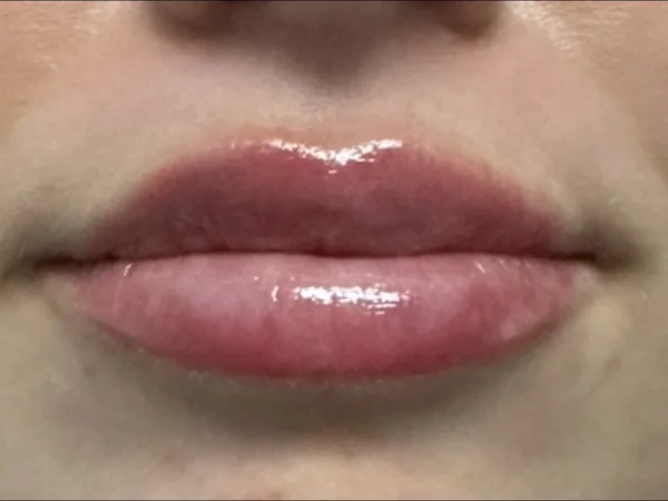 Right after: the same guest's lips minutes after lip filler, with swelling