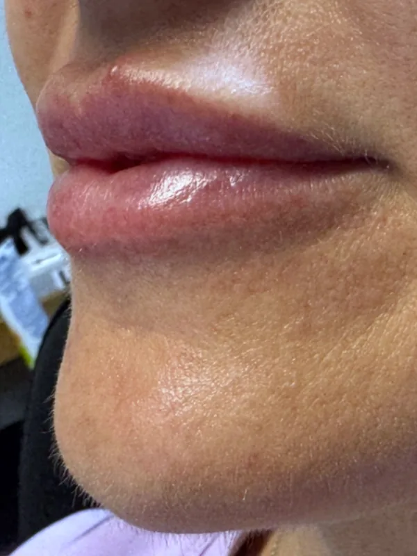 After: the same guest's lips and chin, angled view, after dermal filler