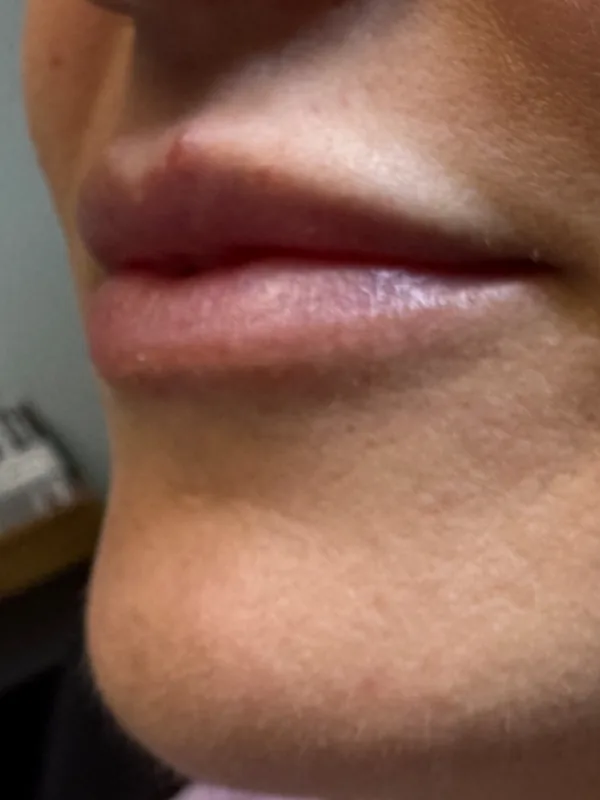 Before: a guest's lips and chin, angled view, before dermal filler