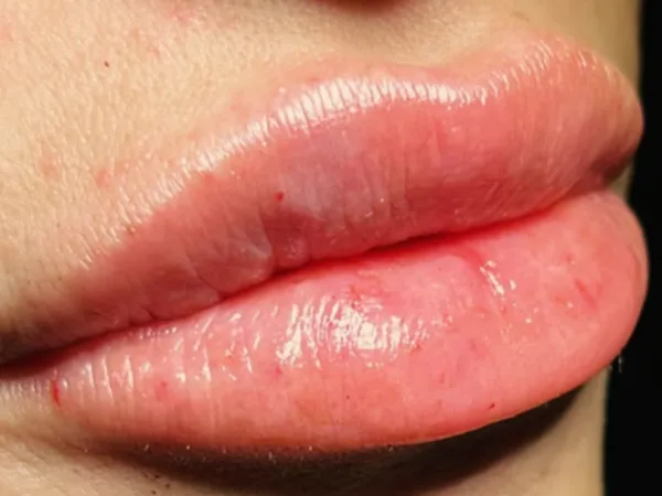 After: the same guest's lips, side view, after lip filler