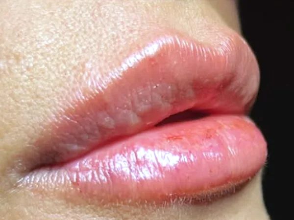 After: the same guest's lips, side view, after lip filler