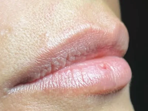 Before: a guest's lips, side view, before lip filler