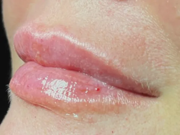 After: the same guest's lips, side view, after lip filler