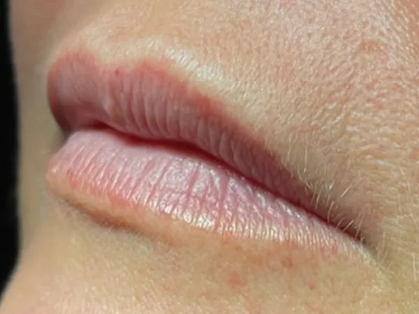 Before: a guest's lips, side view, before lip filler