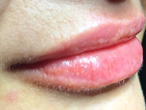 After: the same guest's lips, side view, after lip filler