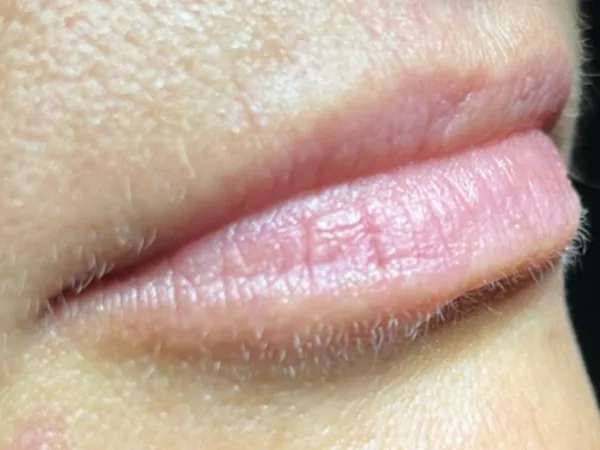 Before: a guest's lips, side view, before lip filler