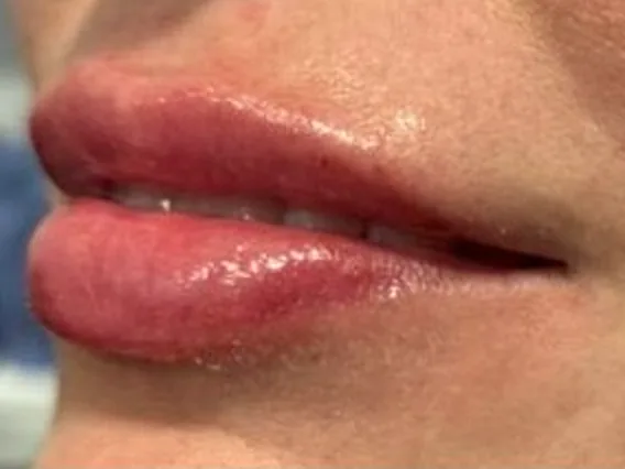After: the same guest's lips, angled view, after lip filler