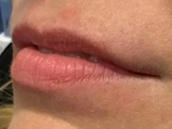 Before: a guest's lips, angled view, before lip filler