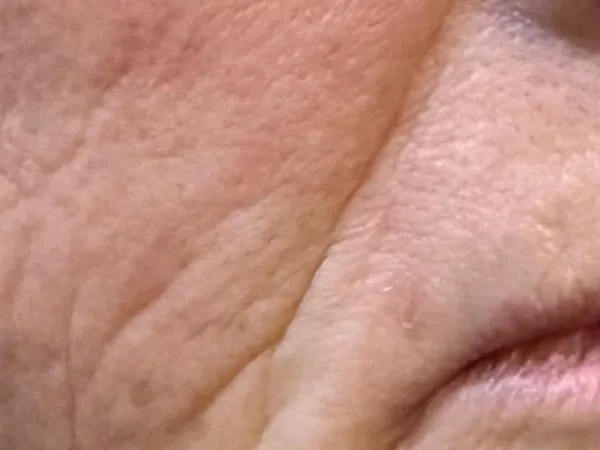 After: the same guest's lower face, after dermal filler