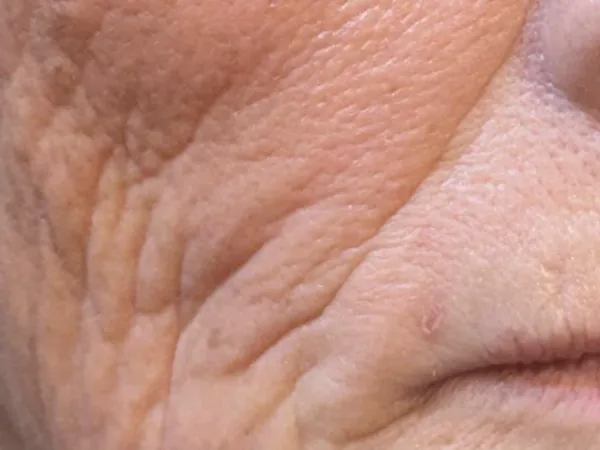 Before: a guest's lower face beside the mouth, before dermal filler