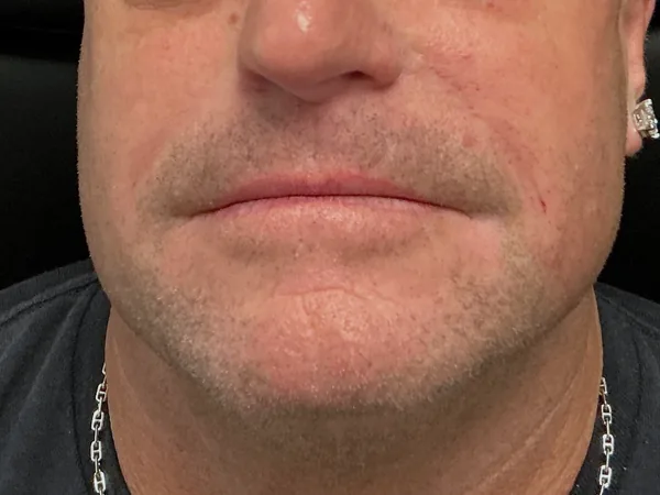 After: the same guest's lower face and chin, front view, two weeks after dermal filler