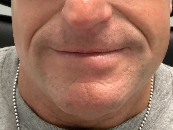 Before: a guest's lower face and chin, front view, before dermal filler