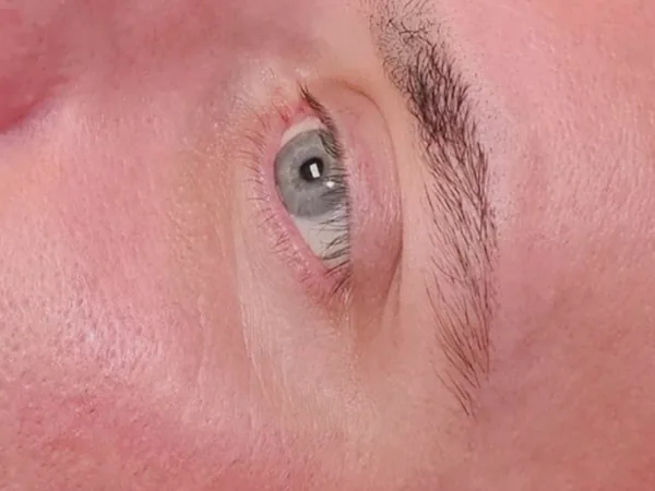 After: the same guest's eye area, two weeks after microneedling