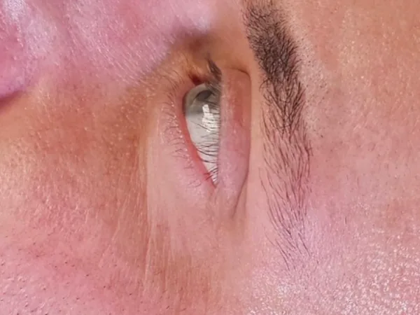 Before: the skin around a guest's eye, before microneedling