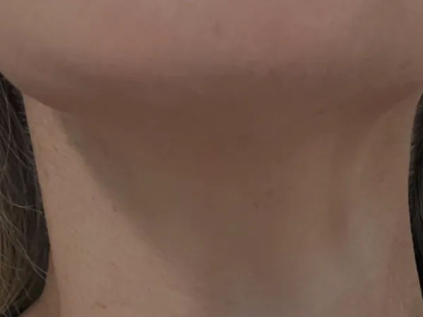 After: the same guest's neck, after tox (neuromodulator) for neck bands
