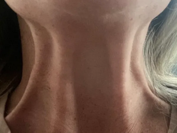 Before: a guest's neck, before tox (neuromodulator) for neck bands