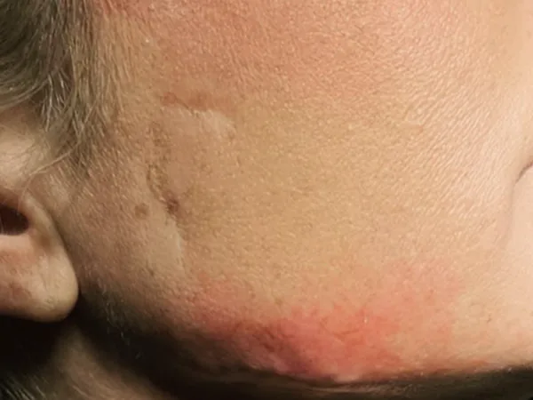 After: the same guest's cheek and jaw, side view, after scar correction with dermal filler