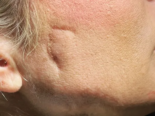 Before: a scar on a guest's cheek and jaw, side view, before scar correction with dermal filler