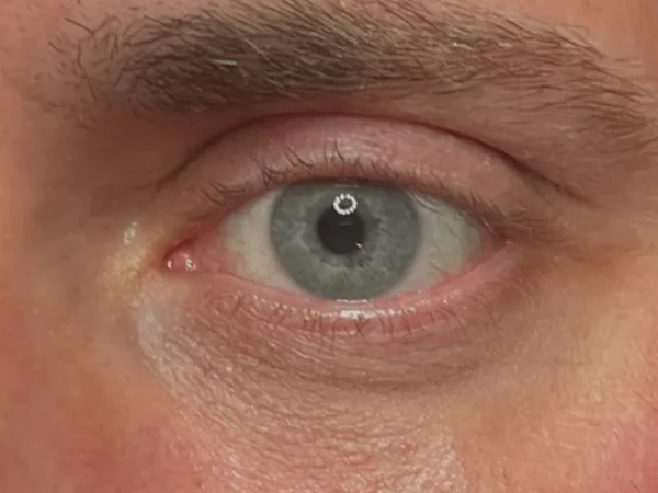 After: the same guest's under-eye area, after under-eye filler