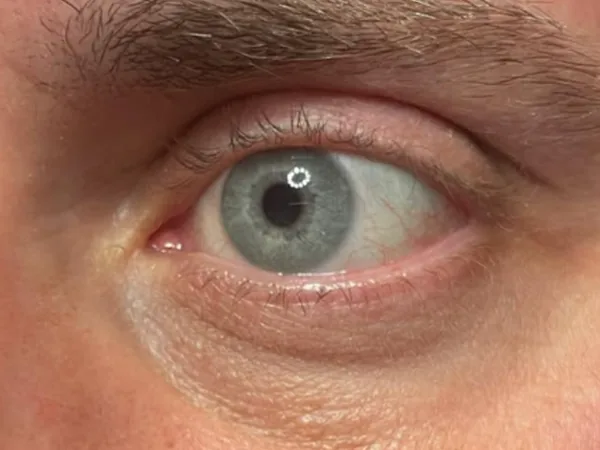 Before: a guest's under-eye area with dark circles, before under-eye filler