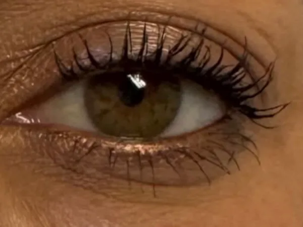 After: the same guest's under-eye area, after PRP under-eye injections