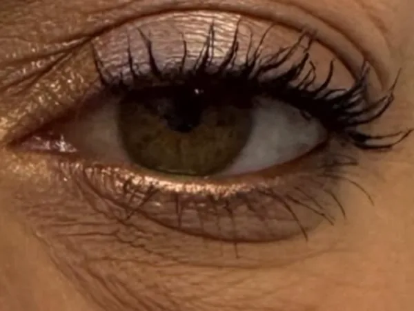 Before: a guest's under-eye area, before PRP under-eye injections