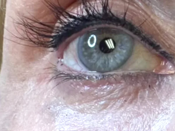 After: the same guest's under-eye area, after PRP under-eye injections