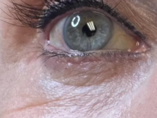 Before: a guest's under-eye area, before PRP under-eye injections